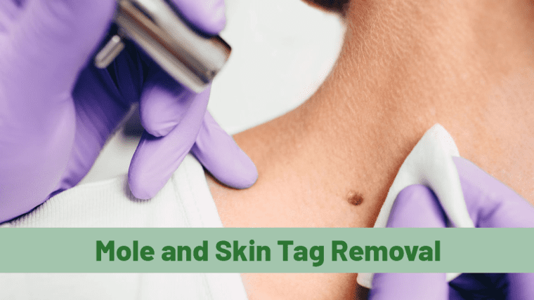 Mole and Skin Tag Removal